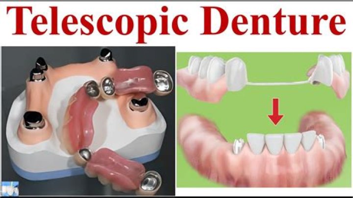 What is a telescopic denture