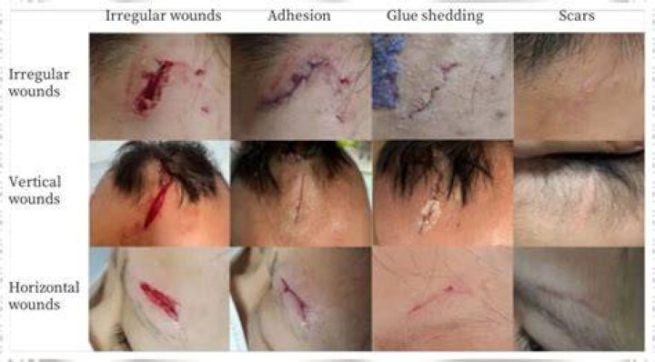 What is a torn ragged wound