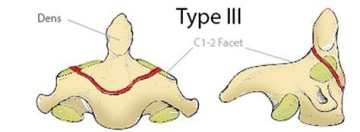 What is a Type III fracture