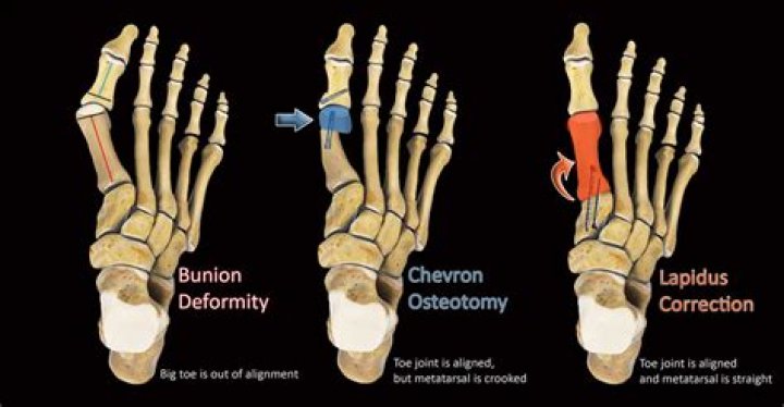 What is an akin Bunionectomy