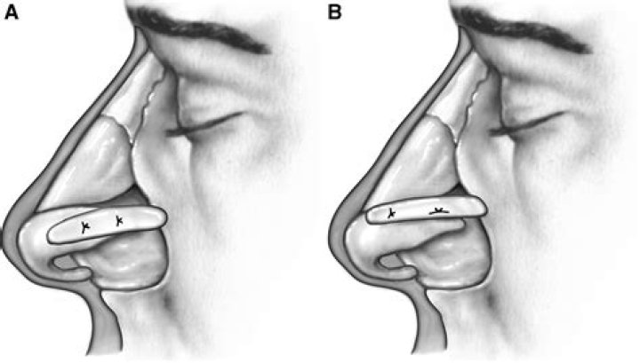 What is an alar batten graft