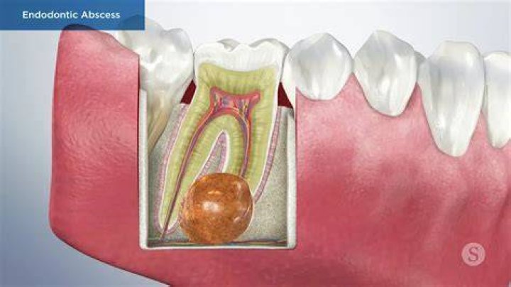 What is apical tooth surgery