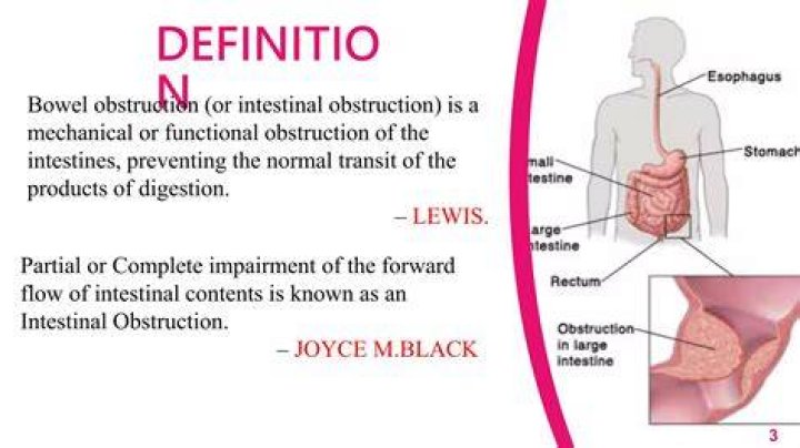 What is complete obstruction