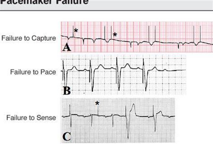 What is failure to pacemaker