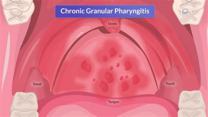 What is granular pharyngitis