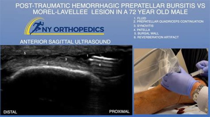 What is hemorrhagic bursitis