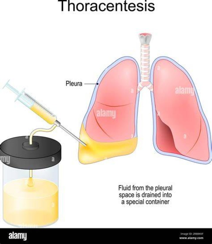 What is needle thoracentesis