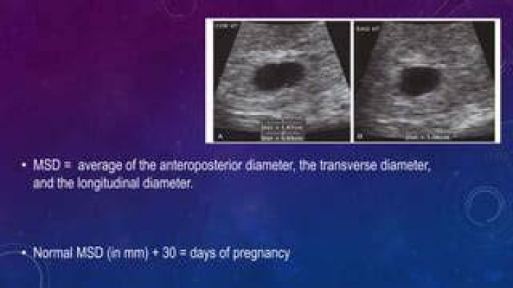 What is normal MSD pregnancy