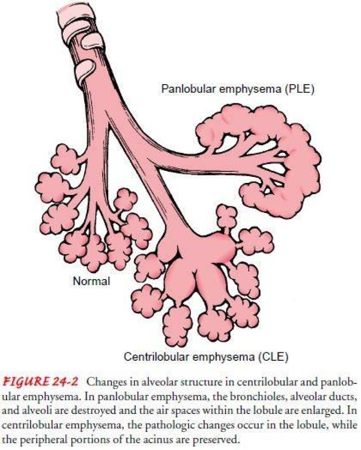 What is Panlobular emphysema