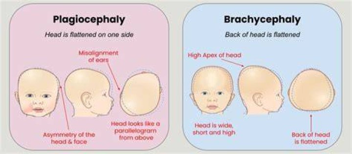 What is severe plagiocephaly