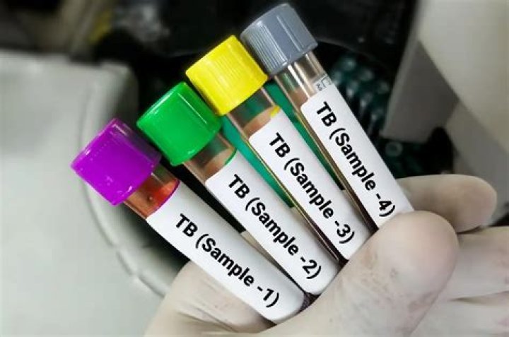 What is the code for TB test