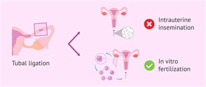 What is the ligation process