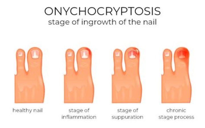 What is the onychocryptosis