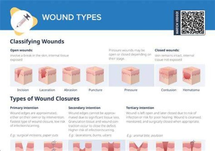 What is wounds and its types