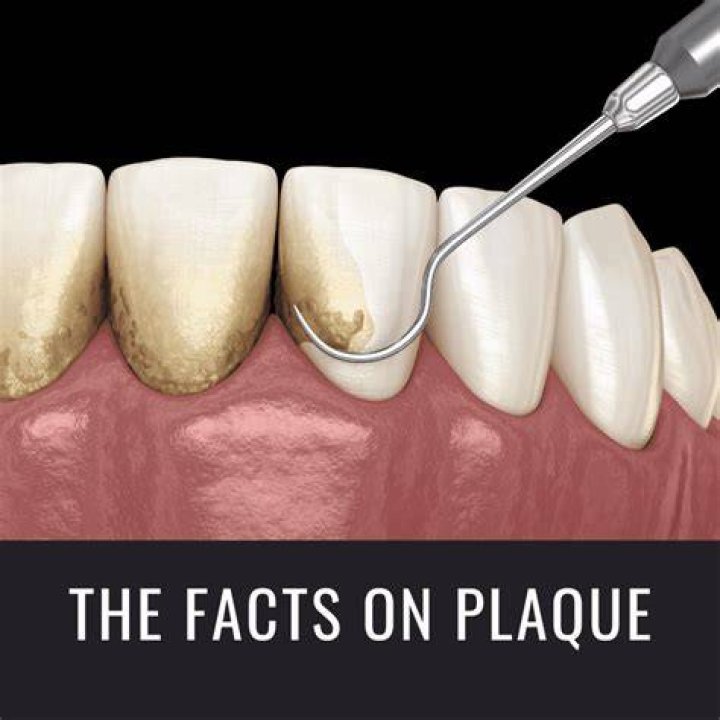 What makes a plaque unstable
