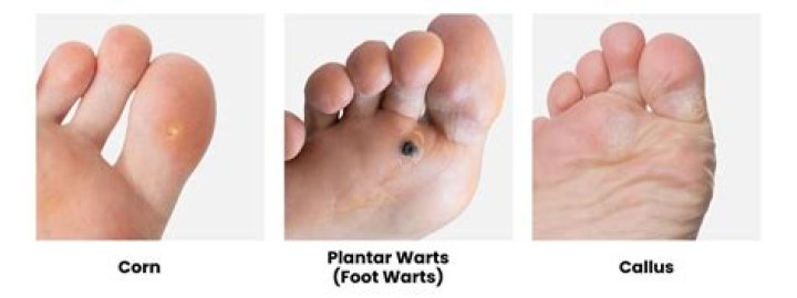 What will dissolve a callus