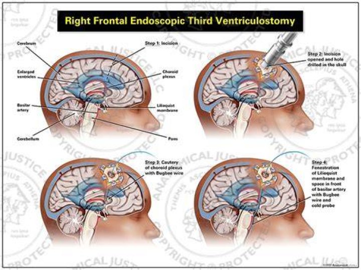 Who needs a ventriculostomy