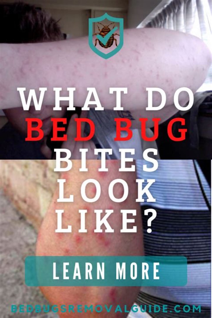 Why do bed bugs bite only me