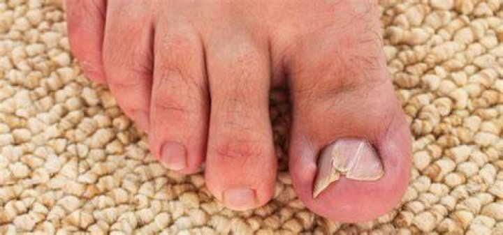 Why do I have short toenails