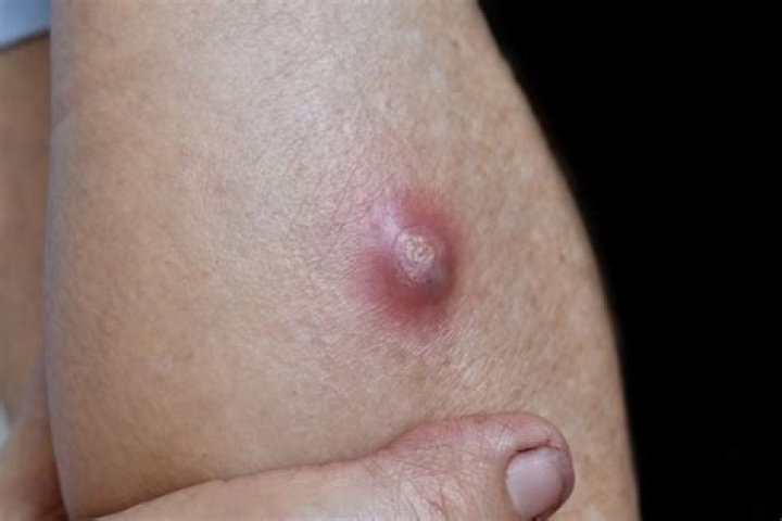 Why do I keep getting staph boils
