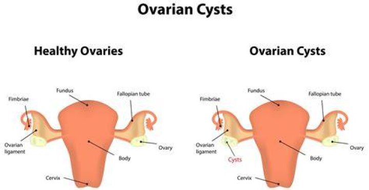 Why do you get adnexal cysts