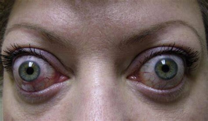 Why does exophthalmos occur